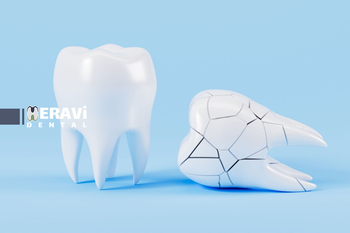 دندان شکسته و خطر عفونت: چرا اقدام فوری حیاتی است؟