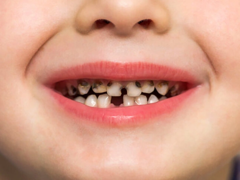 چرا دندان کودک زود خراب میشود؟ بررسی جامع و تخصصی علتهای پنهان پوسیدگی زودرس دندان شیری 9 چرا دندان کودک زود خراب میشود؟ بررسی جامع و تخصصی علتهای پنهان پوسیدگی زودرس دندان شیری